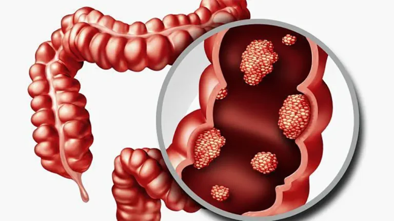 Endoscopic resection of early tumors & polyps