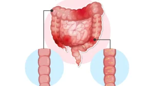 Management of IBS and inflammatory bowel conditions