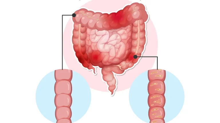 Management of IBS and inflammatory bowel conditions
