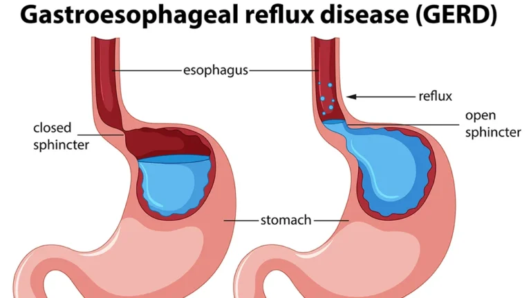 Non-surgical treatment of chronic GERD