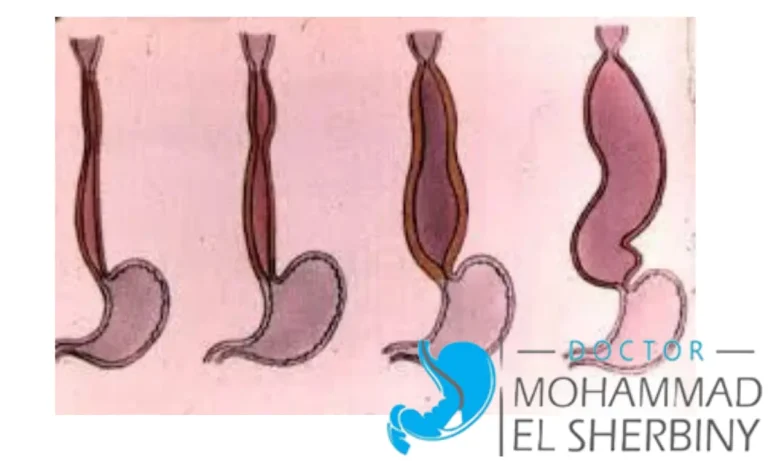 اسباب الاكاليزيا