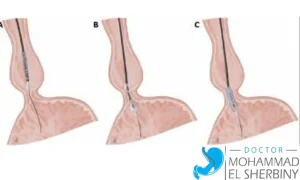 بالون المعدة لعلاج الأكاليزيا
