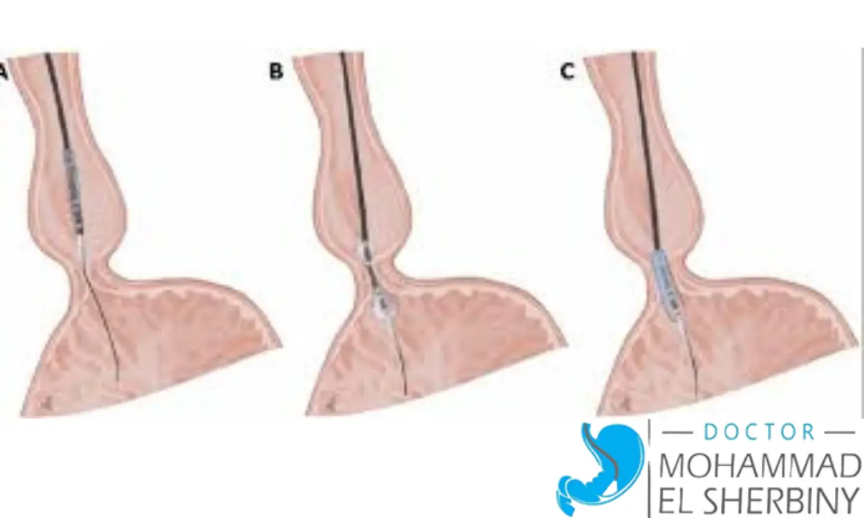 بالون المعدة لعلاج الأكاليزيا