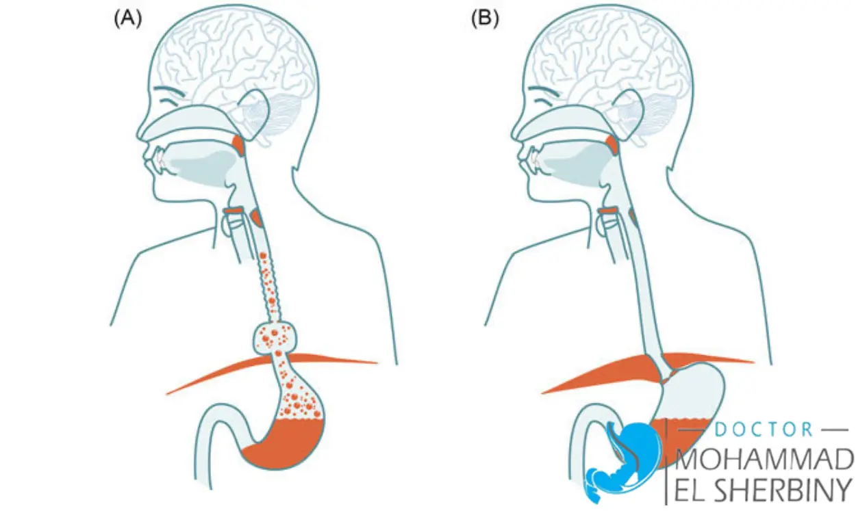 صعوبة البلع بعد عملية فتق الحجاب الحاجز
