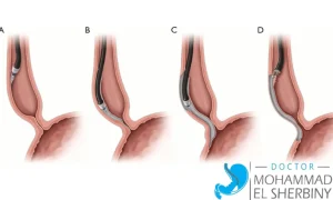 علاج مرض الأكاليزيا