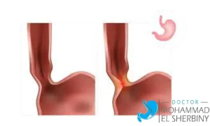 مرض الأكالازيا