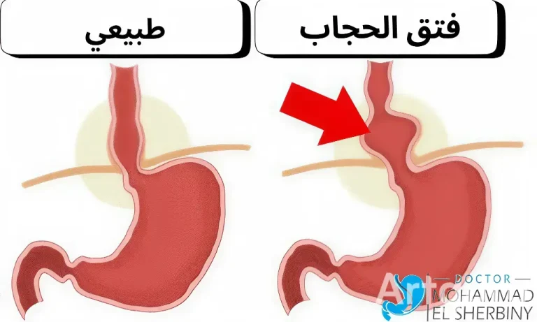 اضرار عملية فتق الحجاب الحاجز