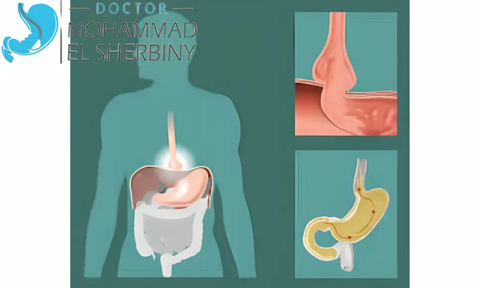 هل فتق الحجاب الحاجز خطير
