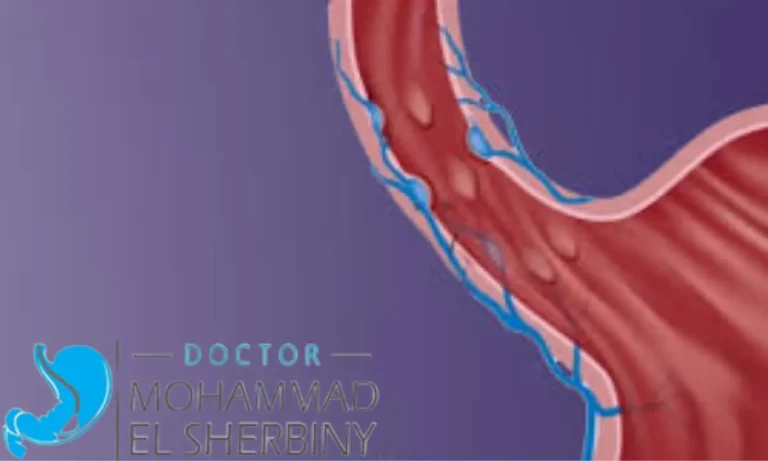 أعراض دوالي المريء