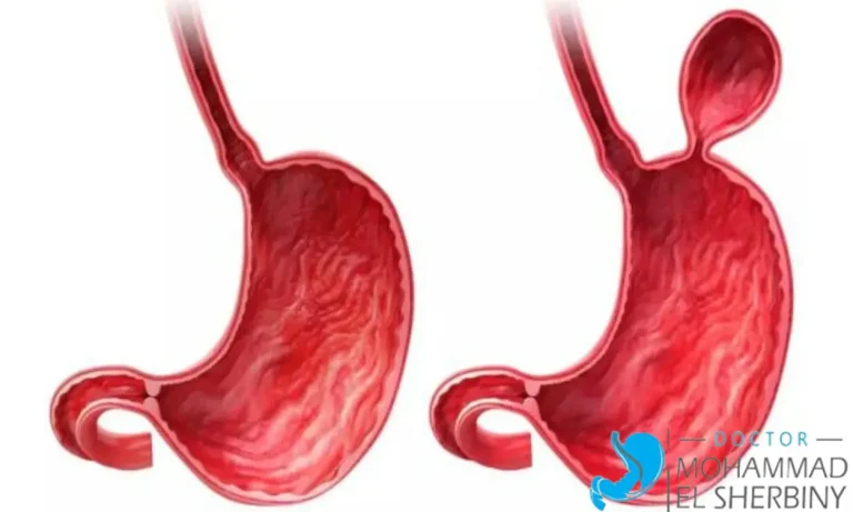علاج فتق الحجاب الحاجز بدون جراحة