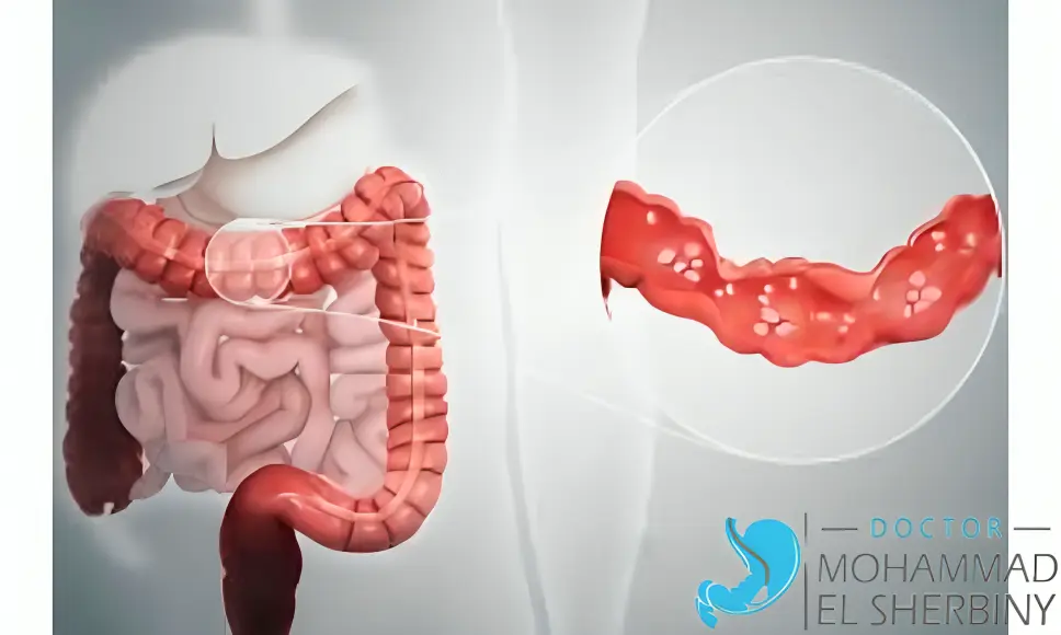 علاج نهائي لالتهاب القولون التقرحي