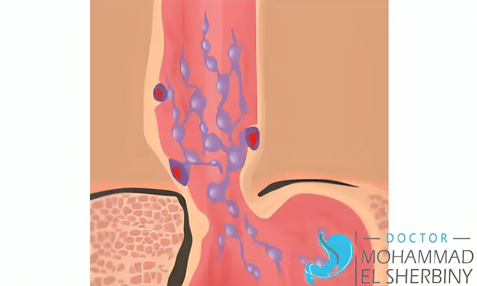 هل دوالي المريء خطيرة