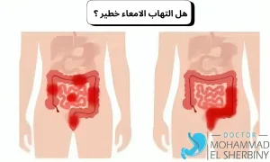 هل التهاب الامعاء خطير