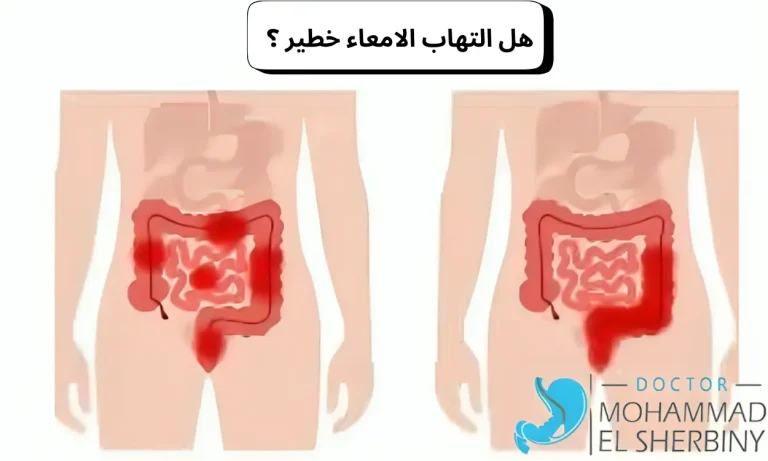 هل التهاب الامعاء خطير