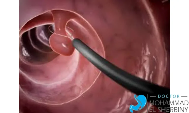 إزالة لحمية القولون بالمنظار