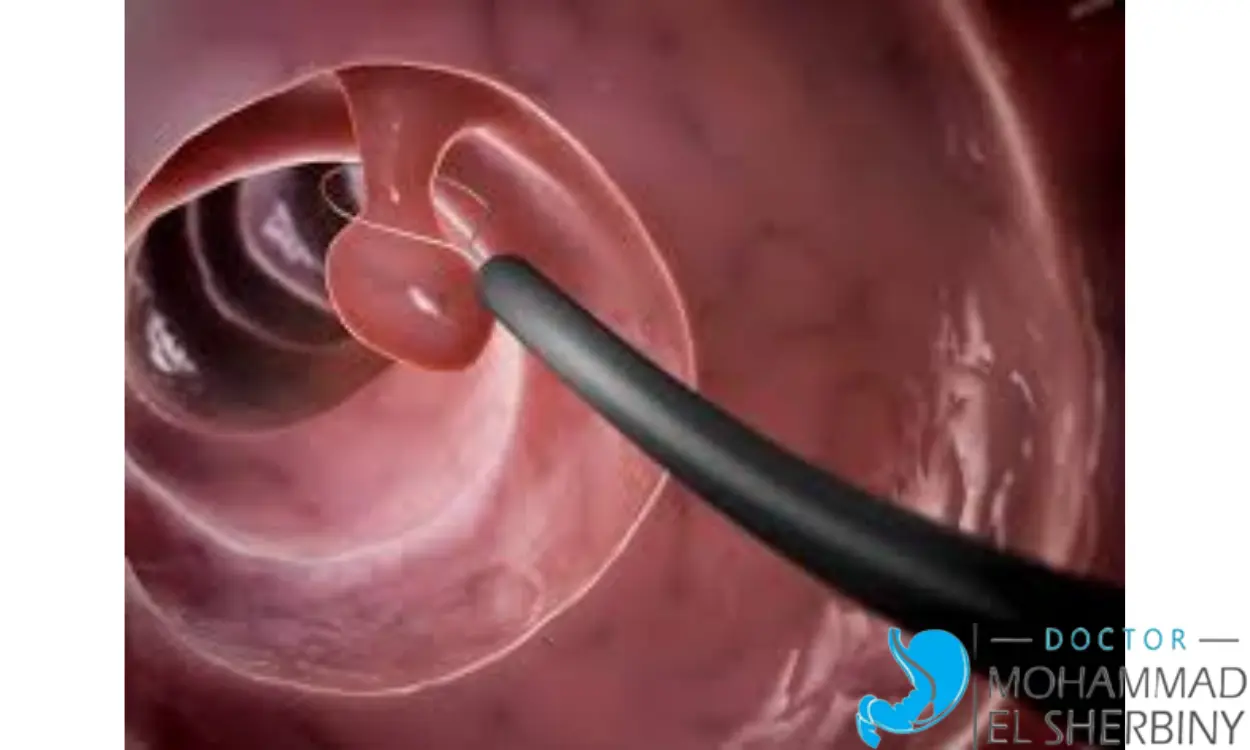 إزالة لحمية القولون بالمنظار