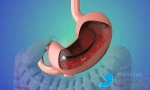 استئصال ورم خبيث بالمعدة بدون جراحة