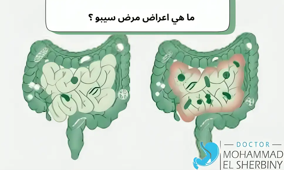 اعراض مرض سيبو sibo