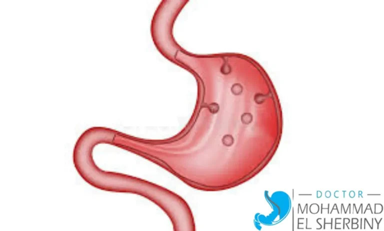 علاج ورم المعدة الحميد