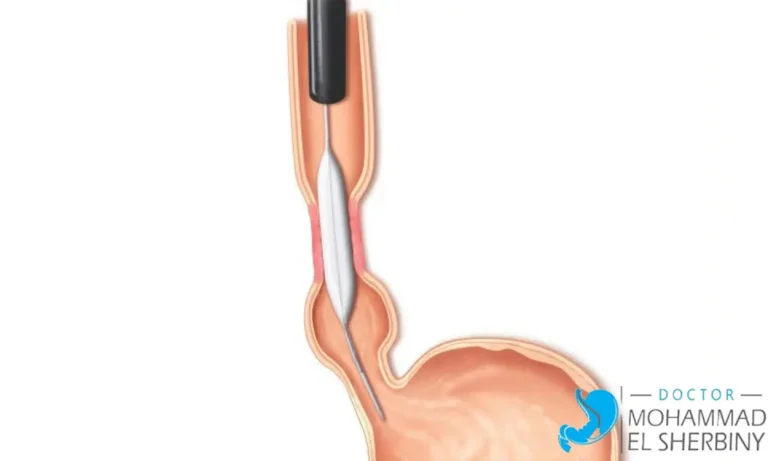 علاج ضيق المريء بدون جراحة