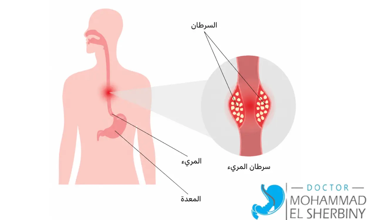 أعراض سرطان المريء المبكر