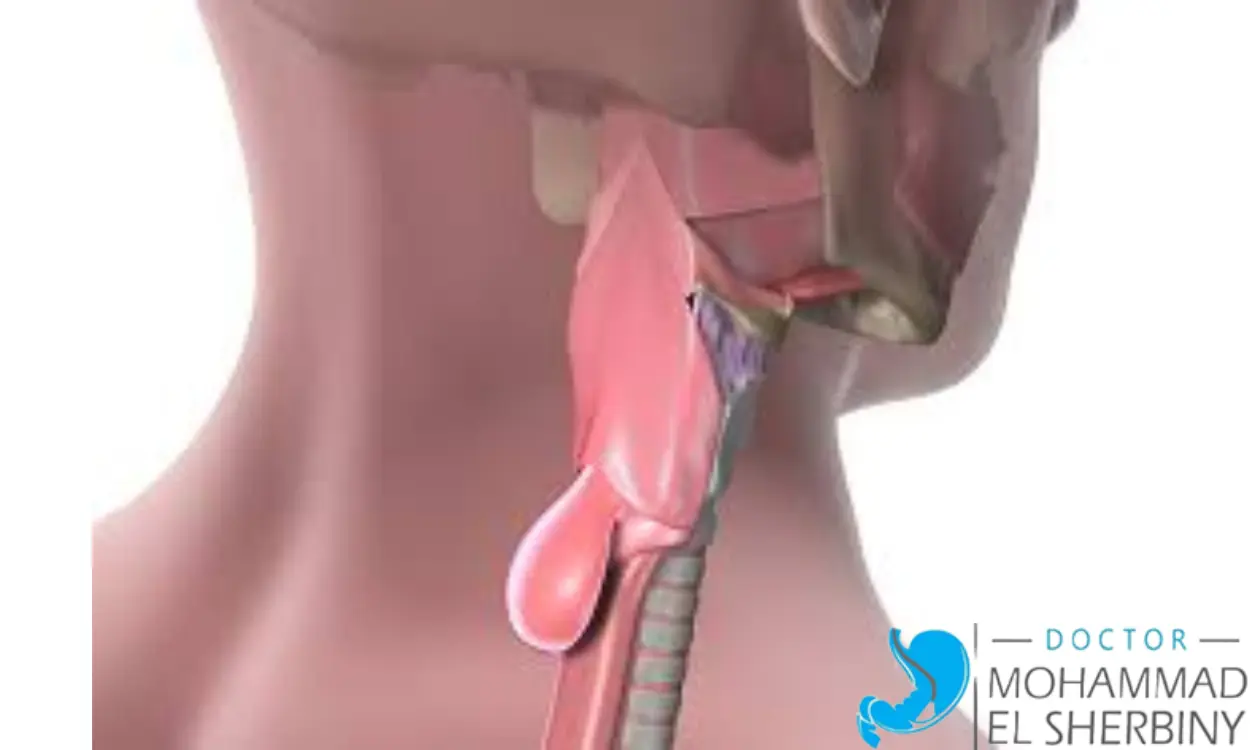 علاج رتج زنكر بالمنظار