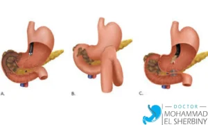علاج ضيق بواب المعدة بالمنظار