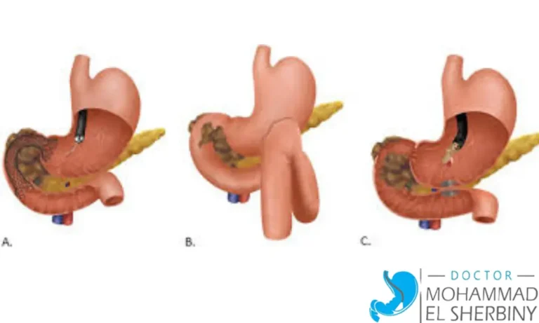 علاج ضيق بواب المعدة بالمنظار