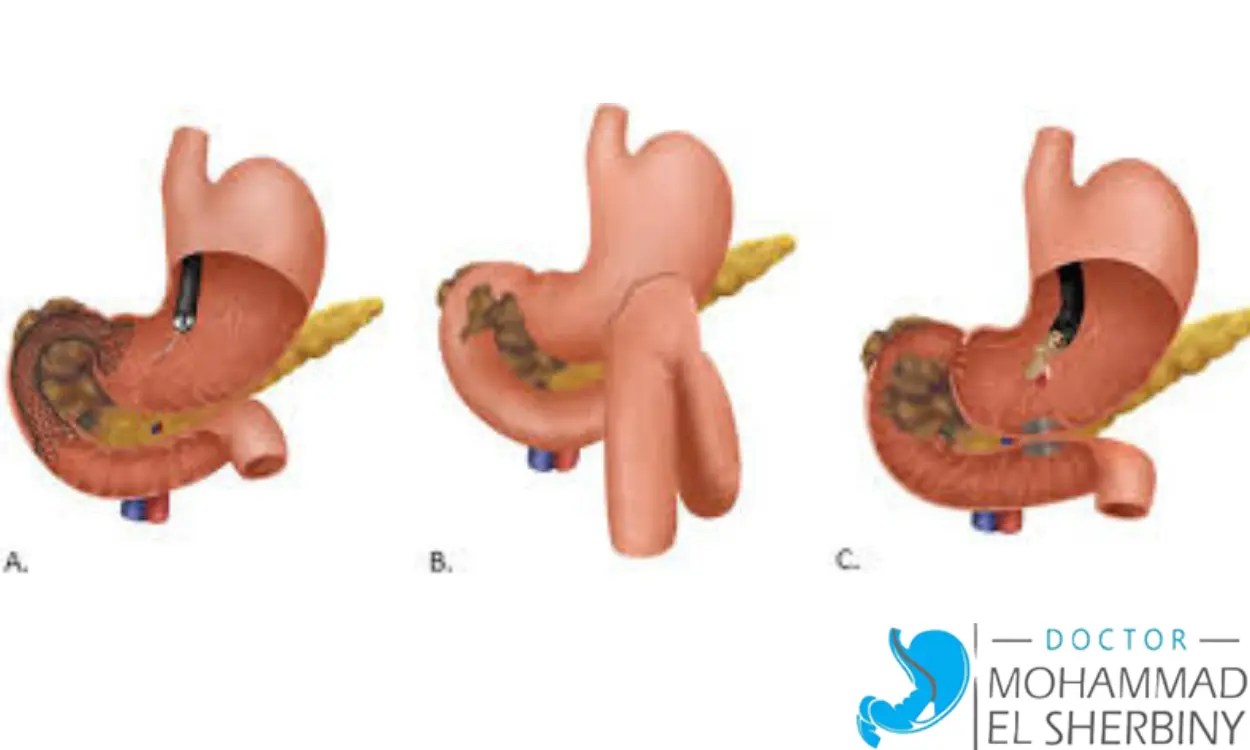 علاج ضيق بواب المعدة بالمنظار
