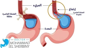 من هو أفضل طبيب لعلاج صمام المريء في مصر -د. محمد الشربيني